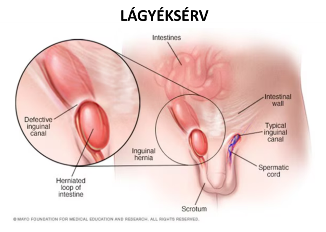 Lágyéksérv anatómiai illusztráció