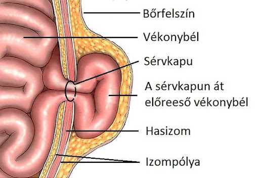 Hernia cross-section – hernia orifice, hernia sac, hernia contents