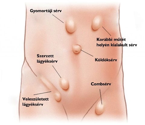 Types of hernias on the body