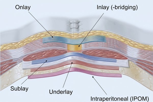 Sérvhálók beültetési pozíciói – anatómiai ábra