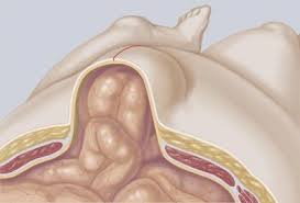 Hegsérv illusztráció – hasfali sérv a műtéti heg területén