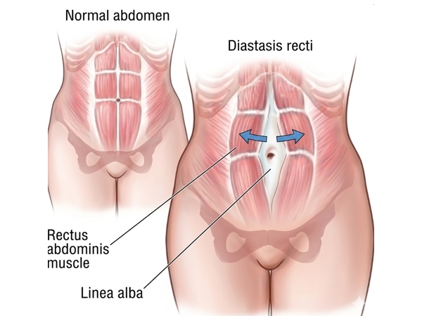 Rectus diastasis illusztráció – normál és szétváló hasizmok