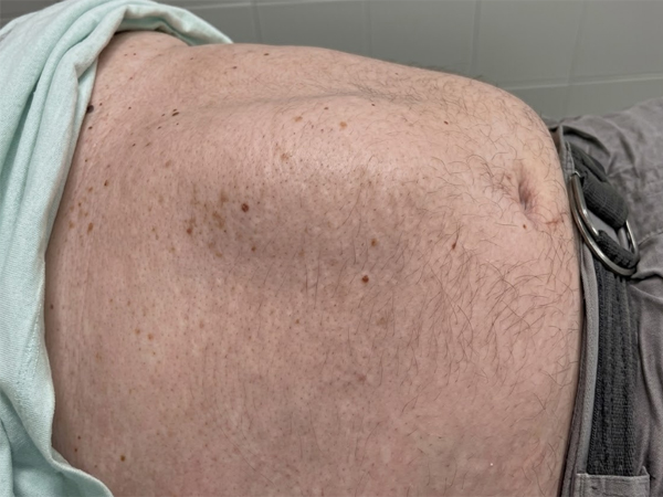 Rectus diastasis illusztráció – normál és szétváló hasizmok