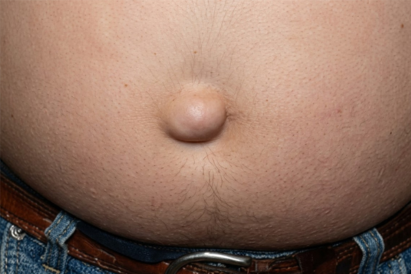 Köldöksérv klinikai kép